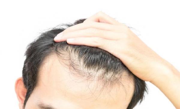 علل ریزش مو و درمان گیاهی آن