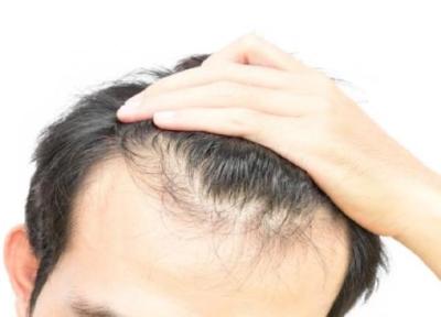 علل ریزش مو و درمان گیاهی آن