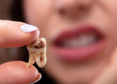 از دلیل تا درمان پوسیدگی دندان